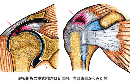 腱板損傷の写真