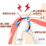 肩関節周囲炎の正しいリハビリ【肩関節専門の理学療法士が教えます】