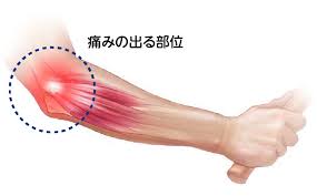 テニス肘の治療方法！ストレッチ、マッサージ方法とサポーターの付け方を理学療法士が教えます！